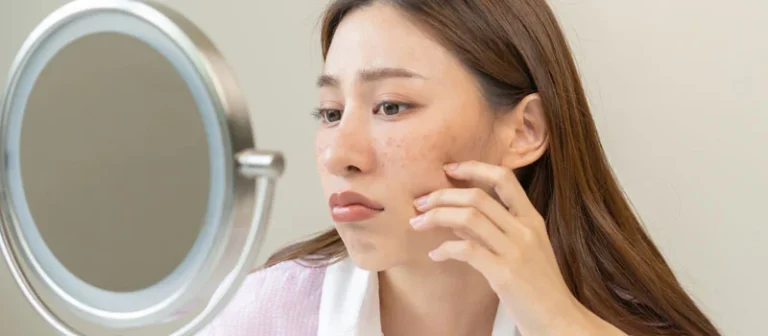 5 Tips Jitu Menghilangkan Flek Hitam Secara Efektif