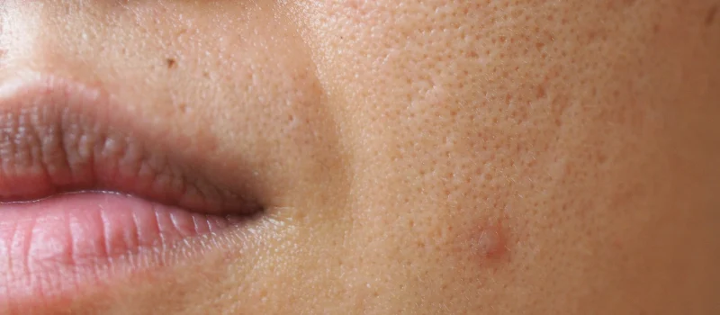 kandungan skincare untuk pori-pori besar