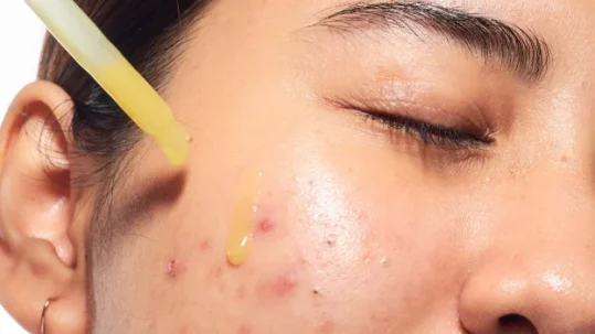 skincare untuk jerawat