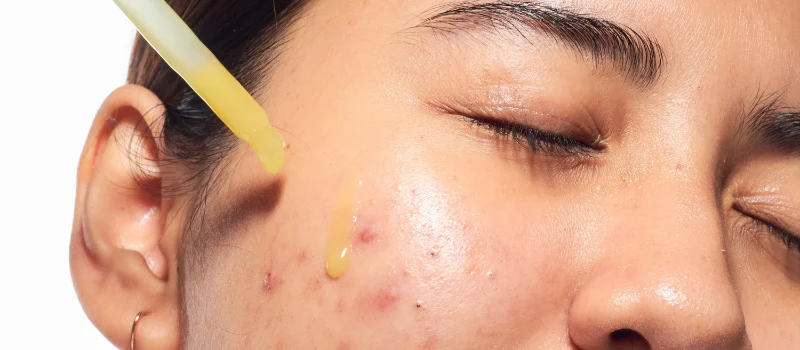 skincare untuk jerawat