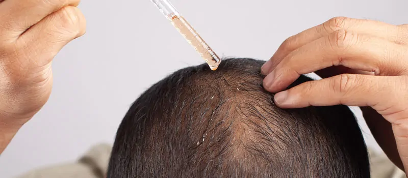 Beragam Kandungan untuk Eksfoliasi Kulit Kepala