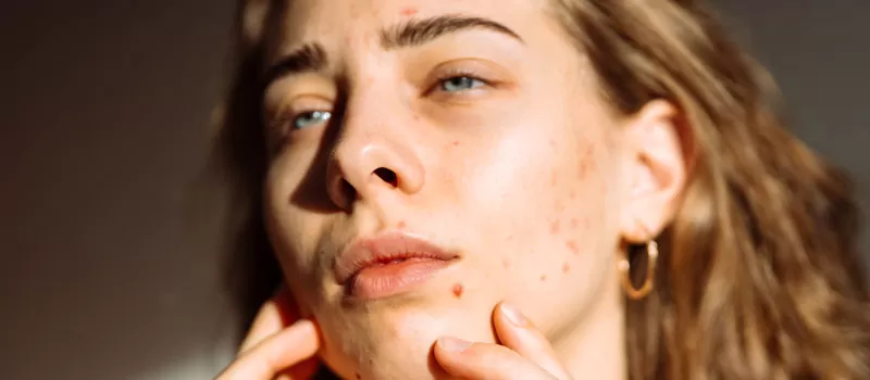 Mengenal Lebih Jauh Manfaat Antioksidan untuk Jerawat