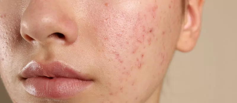 Cara Menghilangkan Bekas Jerawat dengan Bahan Alami