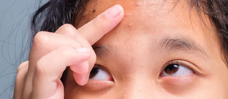 Cara Menghilangkan Bruntusan di Jidat