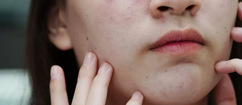 Jenis Jerawat dan Kandungan Skincare yang Tepat