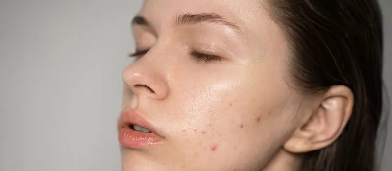 Rekomendasi Kandungan Skincare untuk Kulit Berminyak