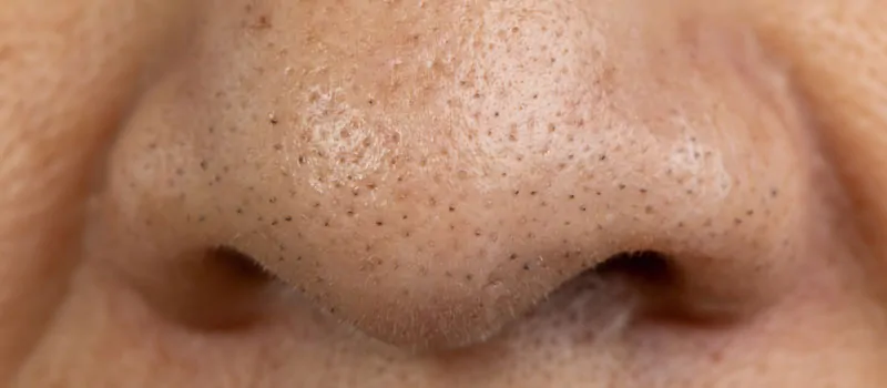 Cara Menghilangkan Blackhead Membandel