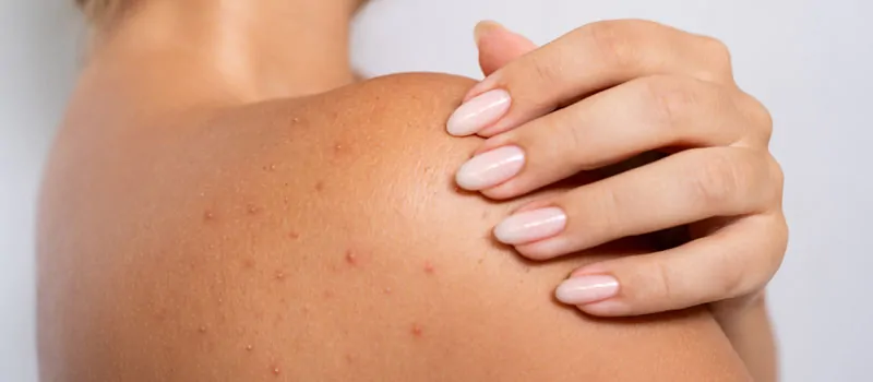 Ini Penyebab Jerawat Punggung yang Sering Dianggap Sepele