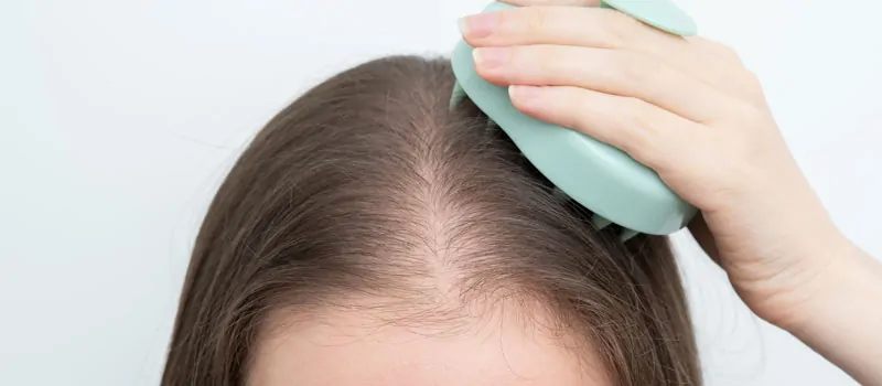 Penyebab Rambut Tipis di Usia Muda