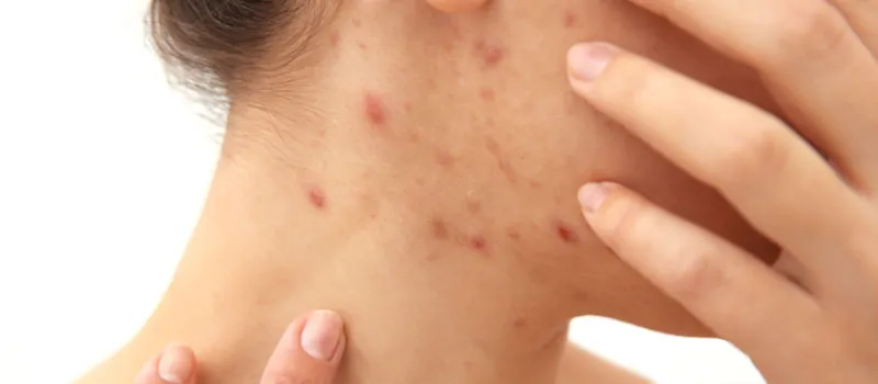Penyebab dan Cara Mengatasi Jerawat di Leher