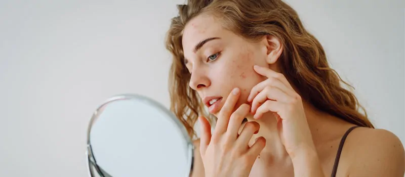 Mengenal Adapalene, Kandungan Skincare yang Mulai Banyak Digunakan