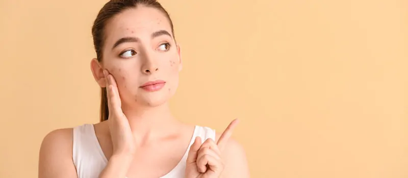 sunscreen untuk kulit berjerawat